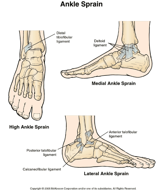 Ankle Sprain:  Illustration