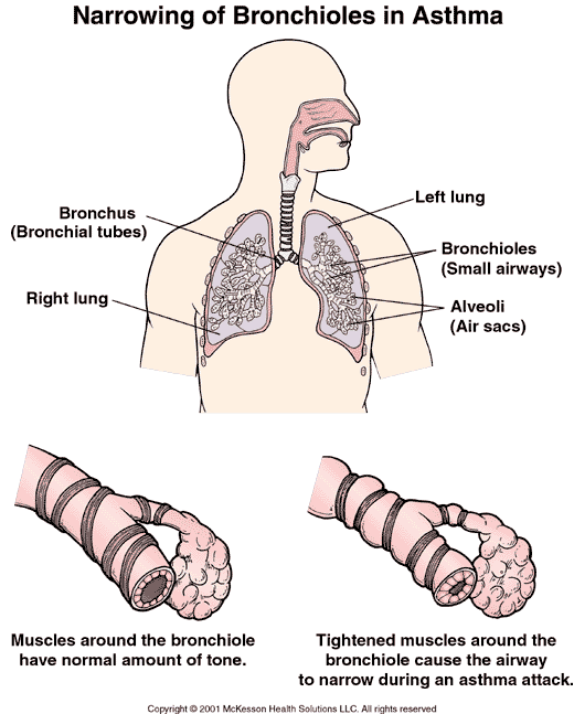 Narrowing of the Bronchioles in Asthma: Illustration