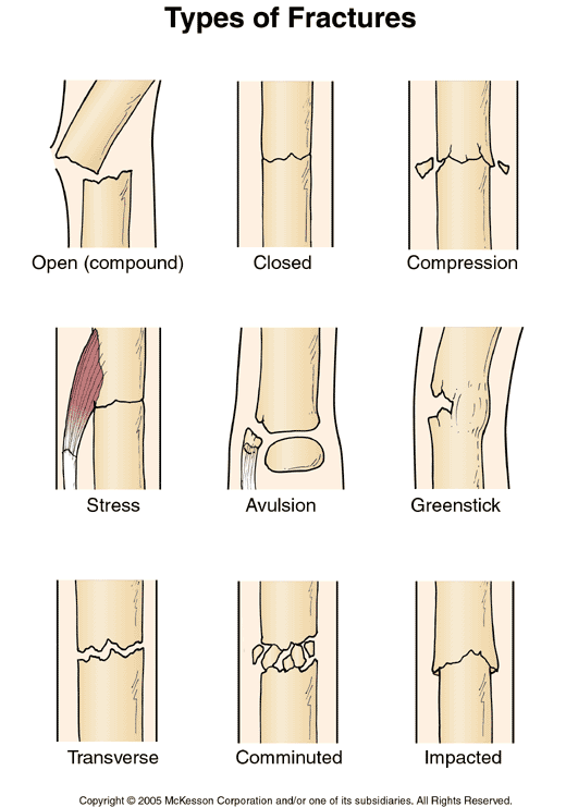 Fracture Types: Illustration
