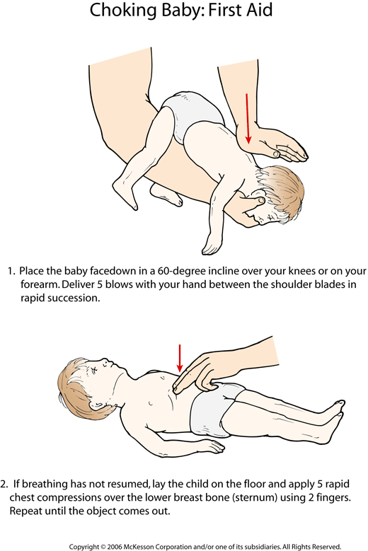 Choking Baby: First Aid: Illustration