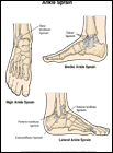 Thumbnail image of: Ankle Sprain:  Illustration