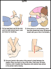 Thumbnail image of: CPR: Illustration
