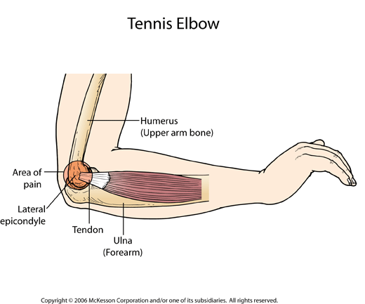Lateral Epicondylitis (Tennis Elbow): Illustration