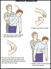 Thumbnail image of: Heimlich Maneuver: Illustration