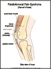 Thumbnail image of: Patellofemoral Pain Syndrome (Runner's Knee):  Illustration