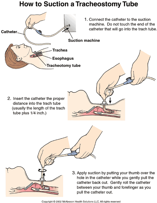 How to Suction a Tracheostomy Tube:  Illustration