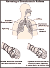 Thumbnail image of: Estrechamiento de los bronquiolos en el asma: ilustración