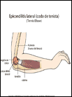 Thumbnail image of: Epicondilitis lateral: ilustracin
