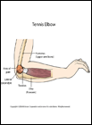 Thumbnail image of: Lateral Epicondylitis (Tennis Elbow): Illustration