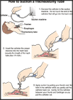 Thumbnail image of: How to Suction a Tracheostomy Tube:  Illustration