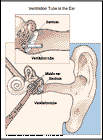 Thumbnail image of: Ventilation Tube in the Ear: Illustration